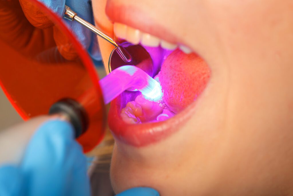 Dental Bonding Video  Tooth Bonding 