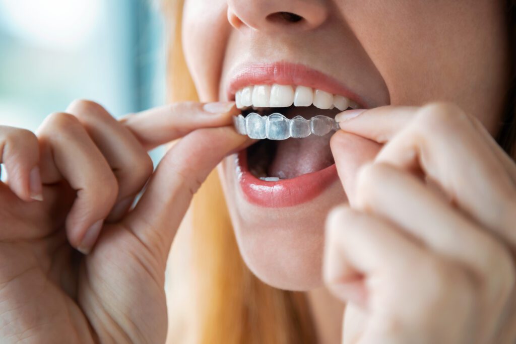 Clear Aligners Vs Braces – Which Should You Choose?