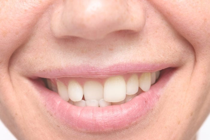 Treat Crooked Teeth in Nashville, Tennessee