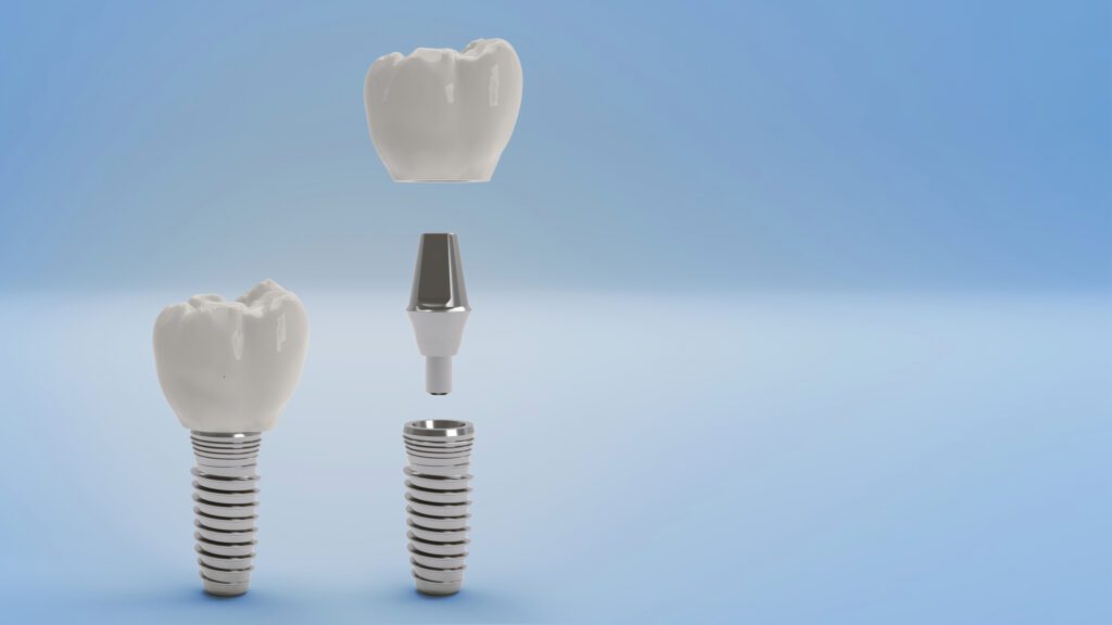 Dental Implants in Nashville, Tennessee