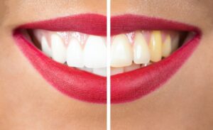 side-by-side comparison of a smile before and after a whitening treatment professional whitening dentist in Nashville Tennessee