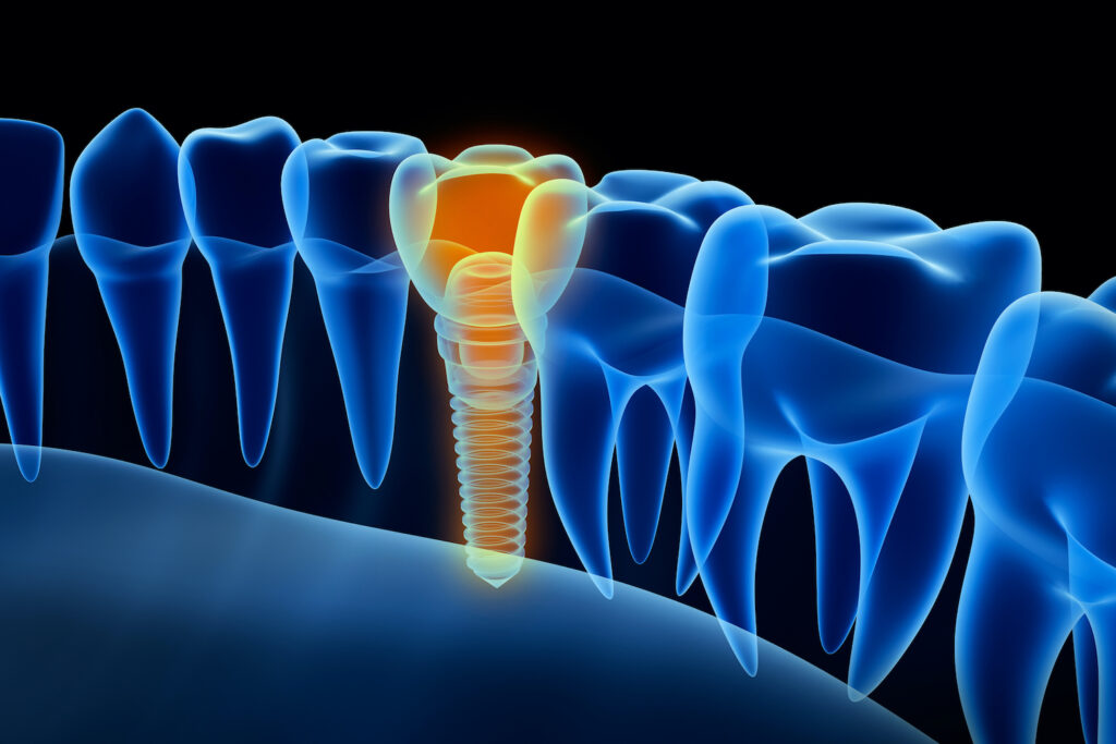 DENTAL IMPLANTS in NASHVILLE TN can help restore your smile if you're missing teeth