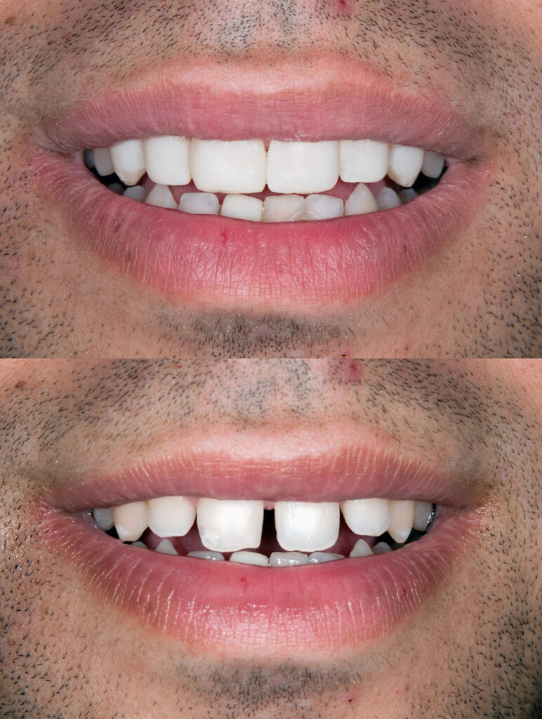 PORCELAIN VENEERS in NASHVILLE TN can help fix your smile in a variety of ways