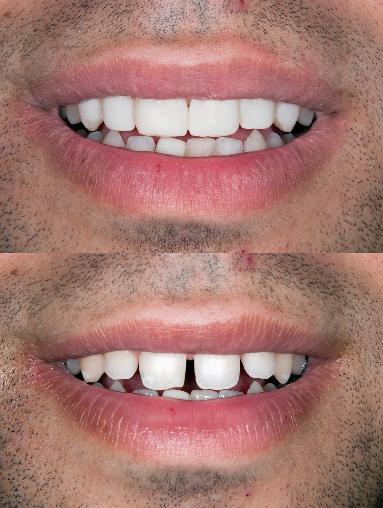 What You Need to Know Porcelain Veneers Nashville, TN, Dentist