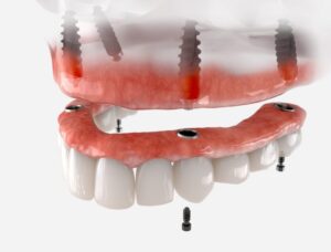 An implant-secured denture could improve comfort