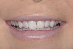 Secondary Gallery Image 5 | Smile Gallery