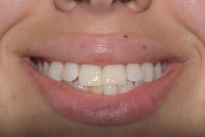 Secondary Gallery Image 1 | Smile Gallery