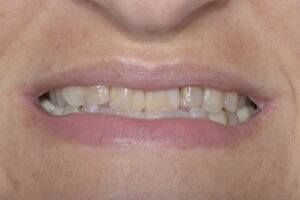 Secondary Gallery Image 7 | Smile Gallery