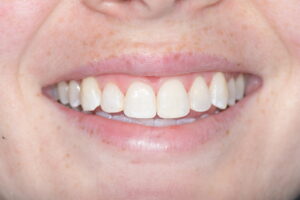 Secondary Gallery Image 8 | Smile Gallery