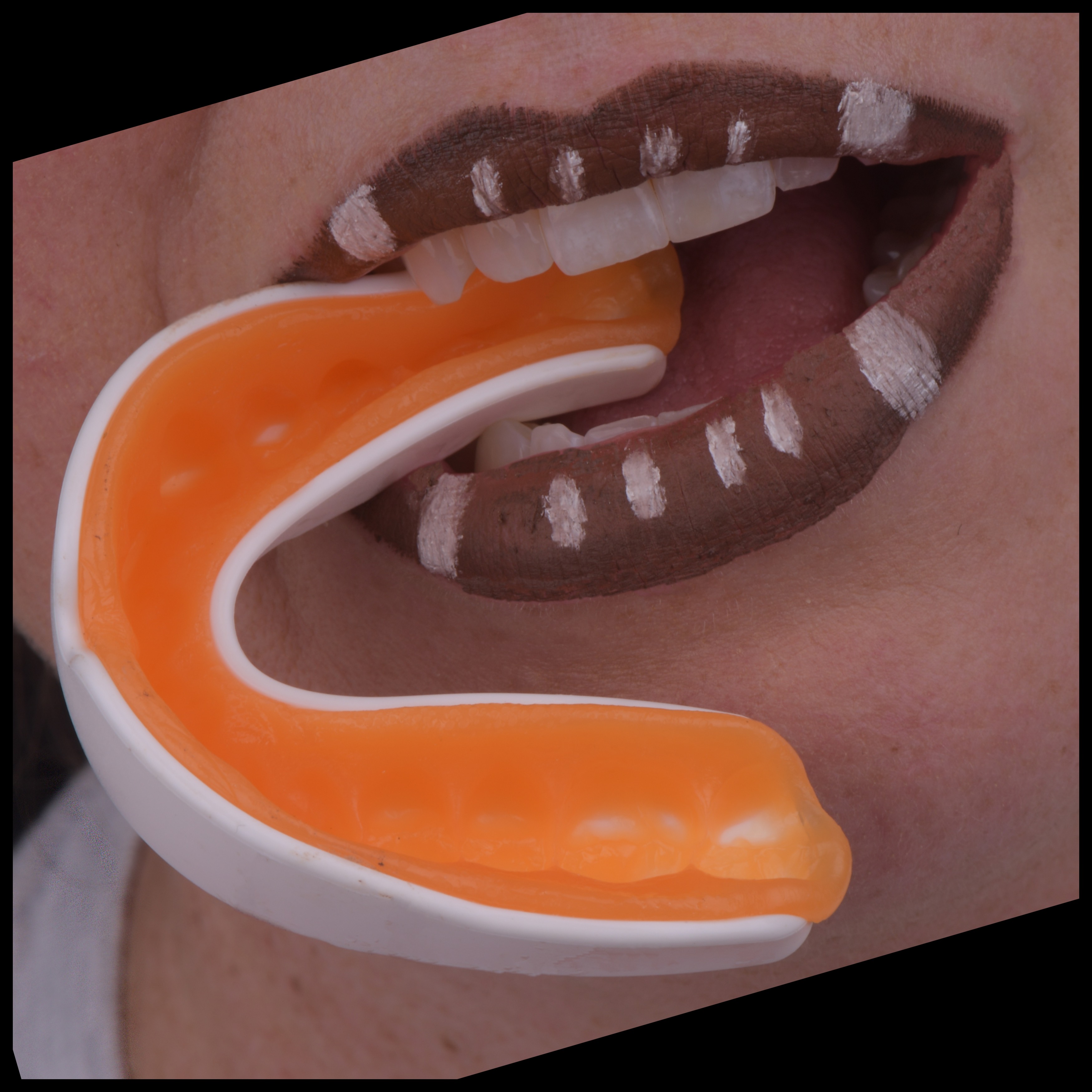 Custom Mouthguard in Nashville, Tennessee