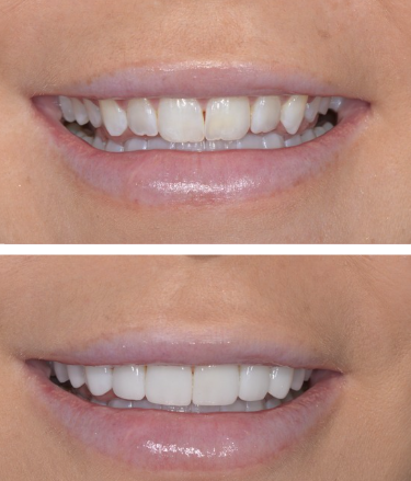 Before and After Minimal Prep Veneers in Nashville TN