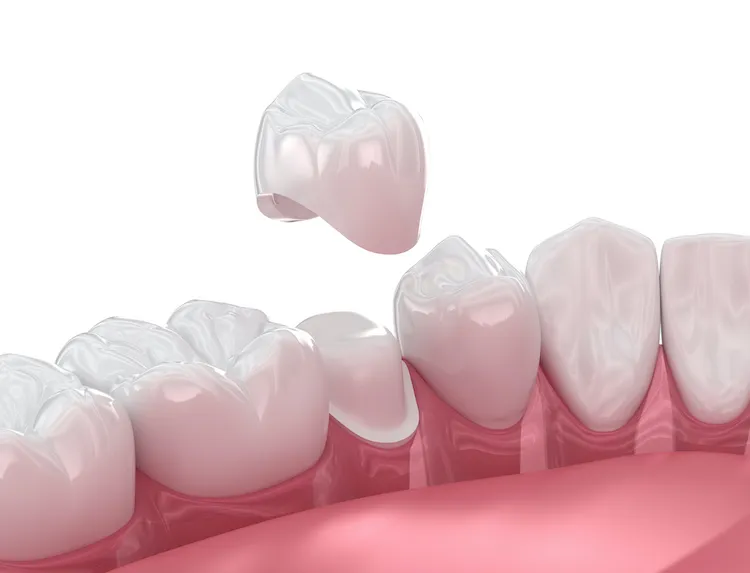 Restoring Your Smile with Metal-Free Materials in Nashville, TN