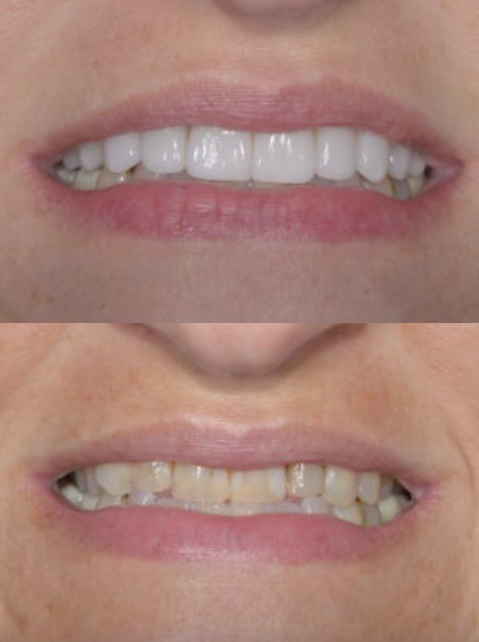 Before and After Restorative Dental Care Nashville TN