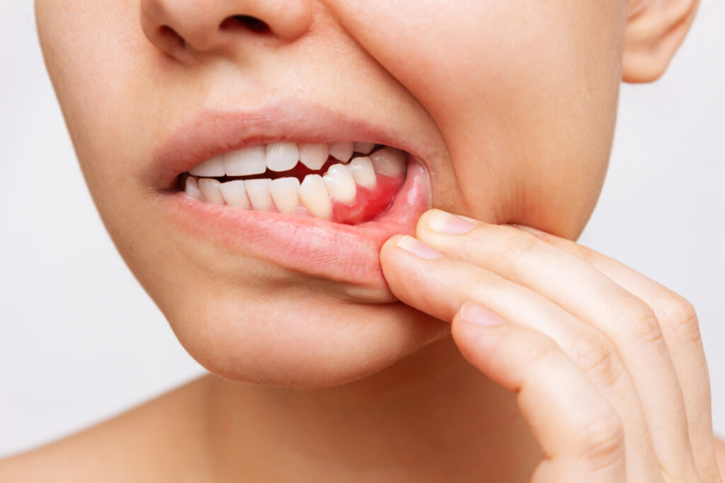Treat Bleeding Gums in our Nashville TN Dental Office