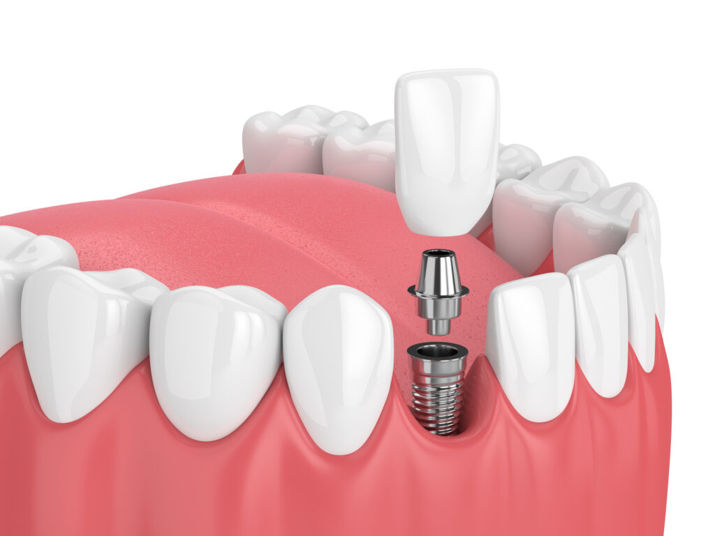 Individual Dental Implant in Nashville TN